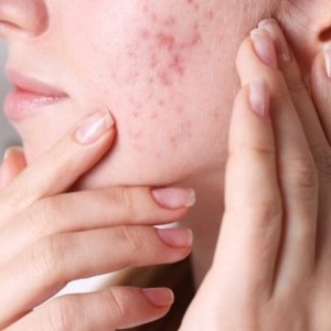 Te confrunți cu acnee hormonală? Află ce poți face, indiferent de vârstă