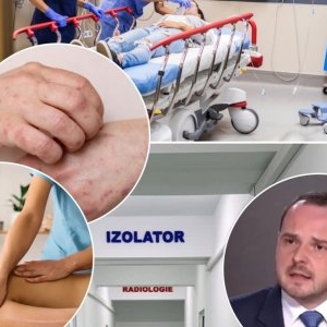 Ce simptome are lepra și cum se transmite. Două maseuze asiatice, care lucrează în Cluj, confirmate cu boala dispărută de aproape jumătate de secol