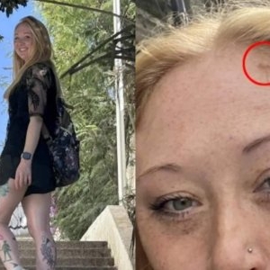 A aflat că are cancer de piele după ce a mers la solar. O artistă a trecut prin 13 intervenții chirurgicale după diagnostic