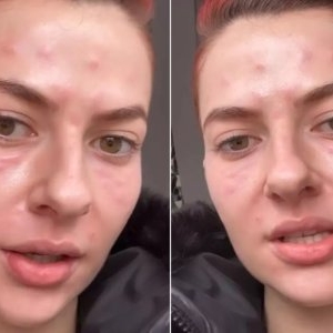 Lidia Buble, imagini îngrijorătoare. Cântăreața a apărut cu pielea umflată și roșie: „Am fața amorțită”. Ce a pățit